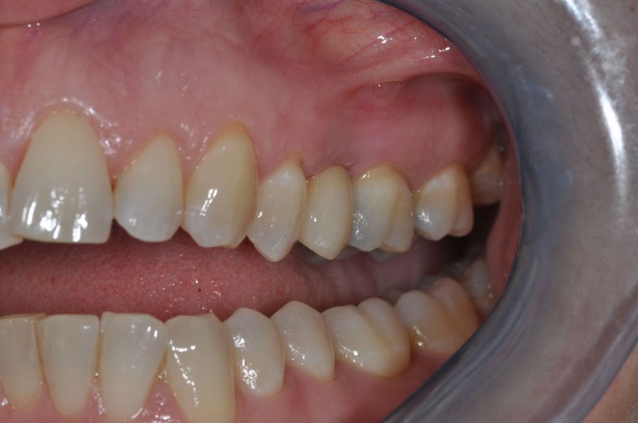 What Material Are Dental Implants Made Of - single tooth Implant - after - 3Dental